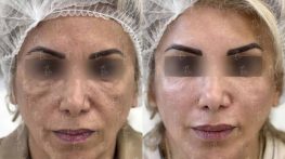 تزریق چربی یا تزریق فیلر برای فرم‌دهی به صورت بهتر است؟