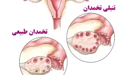 نشانه های تنبلی تخمدان