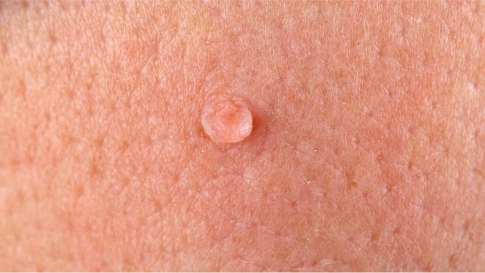 عکس زگیل تناسلی در بارداری