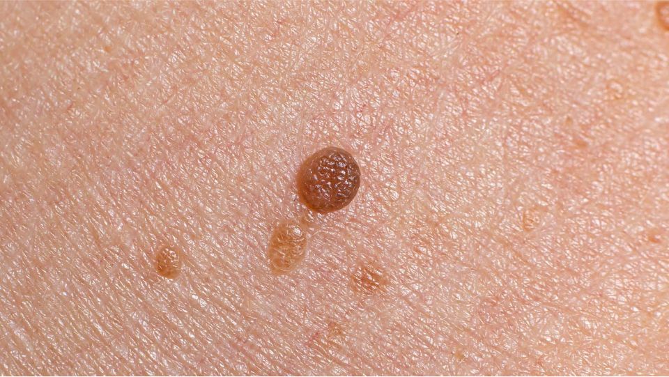 درمان خانگی زگیل تناسلی در بارداری