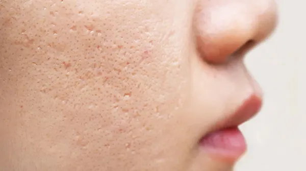 درمان جای جوش عمیق {6 راهکار پزشکی برای از بین بدرن جای جوش و اسکار}  acne scar treatment f