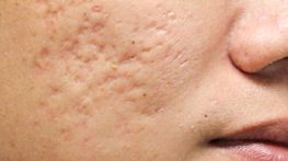 درمان جای جوش عمیق {6 راهکار پزشکی برای از بین بدرن جای جوش و اسکار} درمان جای جوش عمیق