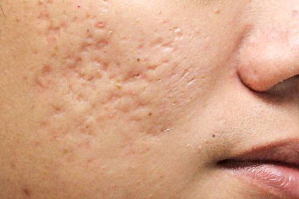 درمان جای جوش عمیق {6 راهکار پزشکی برای از بین بدرن جای جوش و اسکار}  acne5 s