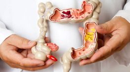 سندروم روده تحریک پذیر چیست؟ نشانه ها و روش درمان IBS سندروم روده تحریک پذیر