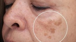 لک قهوه ای صورت