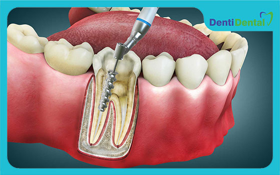 بهترین برندهای مواد اندو در بازار ایران 