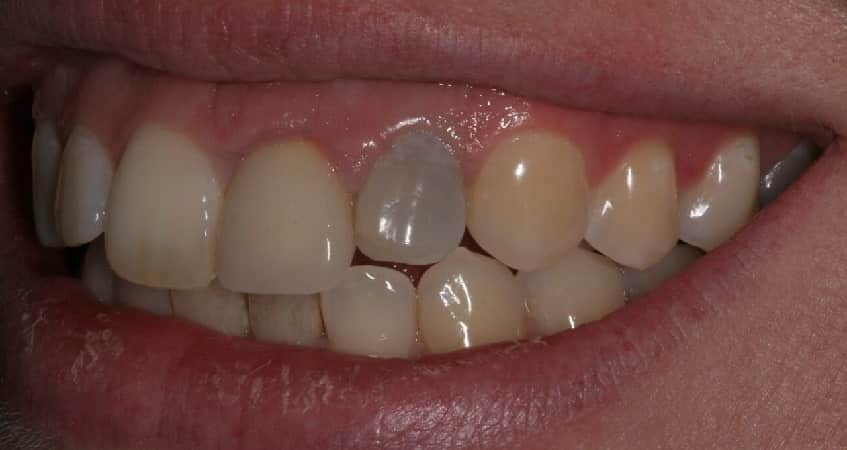 روش های از بین بردن بوی بد روکش دندان | علت، درمان و نکات کلیدی