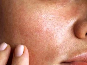 چرب شدن پوست صورت | 4 علت مهم که نباید از آن ها غافل باشیم چرب شدن پوست صورت | 4 علت مهم که نباید از آن ها غافل باشیم