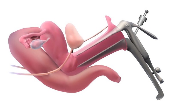 کولپوسکوپی چیست و چگونه انجام می شود؟ و تفاوت با پاپ اسمیر