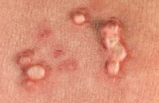 درمان زگیل تناسلی | بهترین و سریع ترین راه درمان زگیل تناسلی کدام است؟