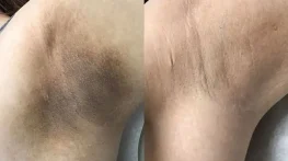 کربن تراپی زیربغل