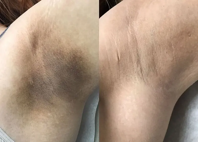 کربن تراپی زیربغل | بررسی مزایا، ماندگاری، مراقبت ها و هزینه کربن تراپی زیربغل | بررسی مزایا، ماندگاری، مراقبت ها و هزینه