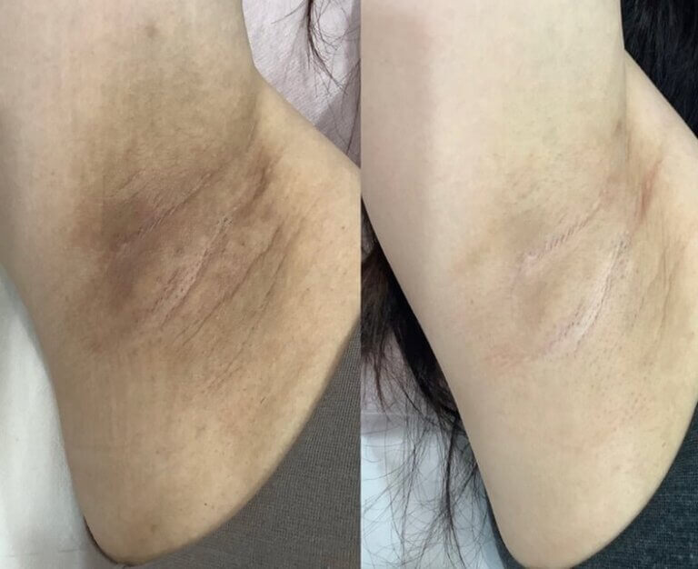 کربن تراپی زیربغل | بررسی مزایا، ماندگاری، مراقبت ها و هزینه کربن تراپی زیربغل | بررسی مزایا، ماندگاری، مراقبت ها و هزینه