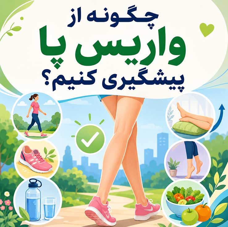 واریس پا چیست؟ بررسی کامل علائم، علتها، روشهای درمان و راههای پیشگیری از واریس پا چگونه از واریس پا پیشگیری کنیم؟