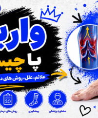 واریس پا چیست؟ بررسی کامل علائم، علتها، روشهای درمان و راههای پیشگیری از واریس پا واریس پا