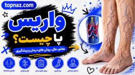 واریس پا چیست؟ بررسی کامل علائم، علتها، روشهای درمان و راههای پیشگیری از واریس پا واریس پا
