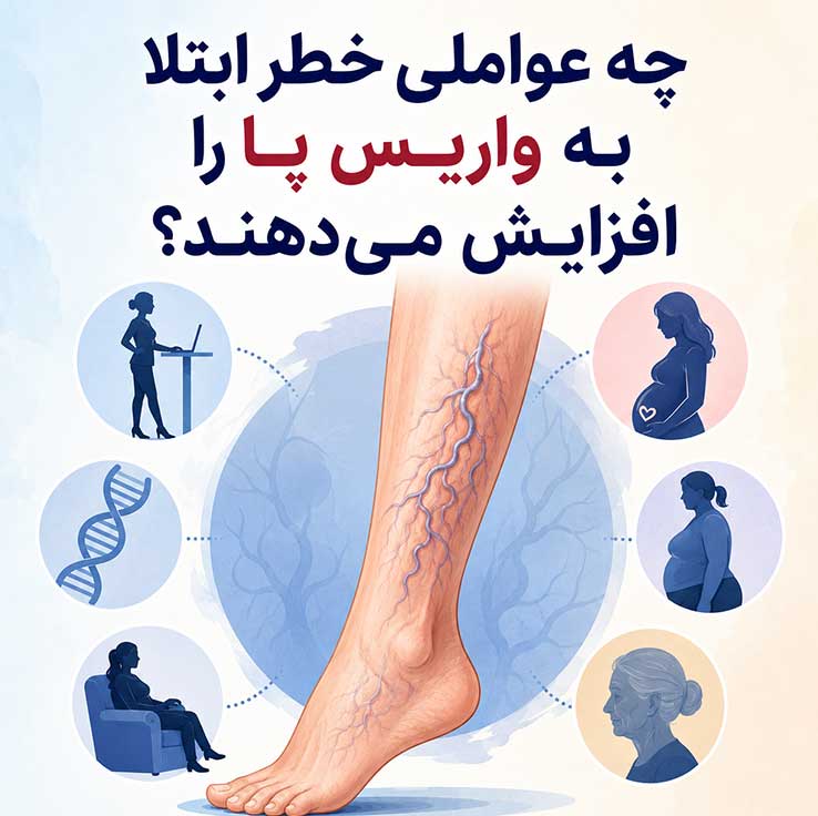 واریس پا چیست؟ بررسی کامل علائم، علتها، روشهای درمان و راههای پیشگیری از واریس پا چه عواملی خطر ابتلا به واریس پا را افزایش میدهند؟