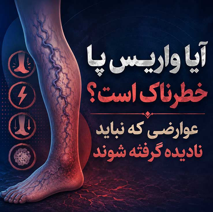 واریس پا چیست؟ بررسی کامل علائم، علتها، روشهای درمان و راههای پیشگیری از واریس پا آیا واریس پا خطرناک است؟ عوارضی که نباید نادیده گرفته شوند