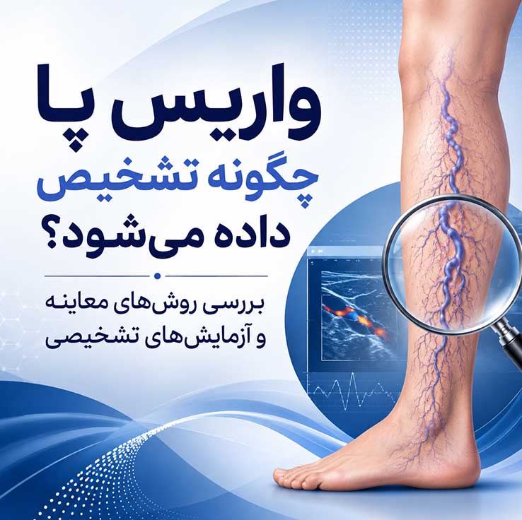 واریس پا چیست؟ بررسی کامل علائم، علتها، روشهای درمان و راههای پیشگیری از واریس پا واریس پا چگونه تشخیص داده میشود؟ بررسی روشهای معاینه و آزمایشهای تشخیصی