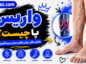واریس پا