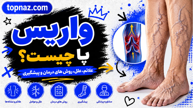 واریس پا چیست؟ بررسی کامل علائم، علتها، روشهای درمان و راههای پیشگیری از واریس پا واریس پا چیست؟ بررسی کامل علائم، علتها، روشهای درمان و راههای پیشگیری از واریس پا